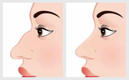 woman face before and after nose surgery